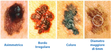 melanoma prevenzione nei